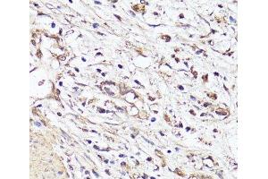 Immunohistochemistry of paraffin-embedded Human stomach cancer using VEGF Monoclonal Antibody at dilution of 1:150 (40x lens). (VEGF anticorps)
