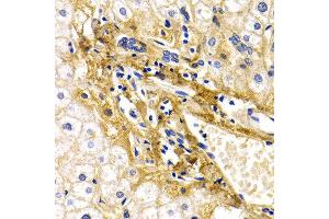 Immunohistochemistry of paraffin-embedded human liver damage using CFH antibody at dilution of 1:200 (400x lens). (Complement Factor H anticorps)