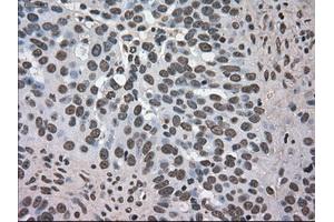 Immunohistochemical staining of paraffin-embedded Adenocarcinoma of colon tissue using anti-DHFRmouse monoclonal antibody. (Dihydrofolate Reductase anticorps)