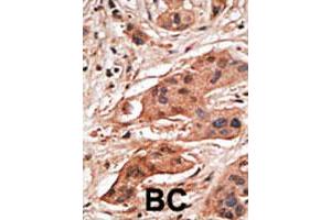 Formalin-fixed and paraffin-embedded human cancer tissue reacted with the BCL2A1 polyclonal antibody  , which was peroxidase-conjugated to the secondary antibody, followed by DAB staining. (BCL2A1 anticorps  (N-Term))