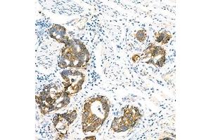 Immunohistochemistry analysis of paraffin-embedded human gastric cancer using LI Cadherin (ABIN7074493) at dilution of 1: 1500