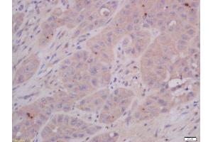 Formalin-fixed and paraffin embedded human laryngocarcinoma tissue labeled with Anti-COMMD4 Polyclonal Antibody, Unconjugated 1:400 followed by conjugation to the secondary antibody and DAB staining. (COMMD4 anticorps  (AA 1-100))