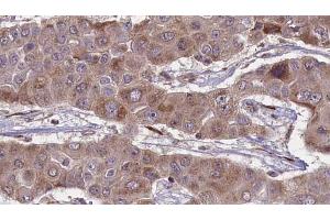 ABIN6269021 at 1/100 staining Human liver cancer tissue by IHC-P. (FSHR anticorps  (Internal Region))