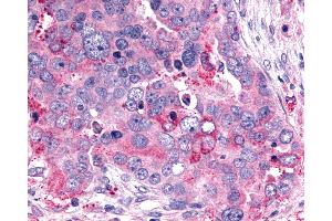 Anti-GHRHR antibody IHC of human Ovary, Carcinoma. (GHRHR anticorps  (C-Term))