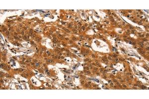 Immunohistochemistry of paraffin-embedded Human gasrtic cancer tissue using DEAF1 Polyclonal Antibody at dilution 1:40 (DEAF1 anticorps)
