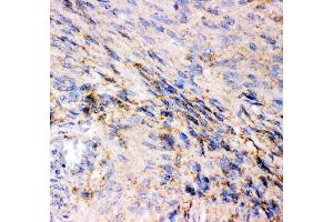 Anti- GRIA1 antibody, IHC(P) IHC(P): Human Meningeoma Tissue