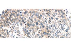 Immunohistochemistry of paraffin-embedded Human lung cancer using IQGAP2 Polyclonal Antibody at dilution of 1/40