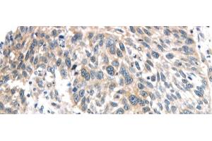 Immunohistochemistry of paraffin-embedded Human lung cancer using IQGAP2 Polyclonal Antibody at dilution of 1/40 (IQGAP2 anticorps)