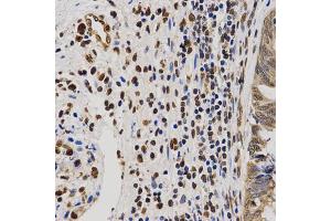 Immunohistochemistry of paraffin-embedded human rectal cancer using Asymmetric DiMethyl-Histone H4-R3 antibody (ABIN1872990) at dilution of 1:200 (40x lens).