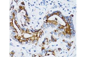 Immunohistochemistry of paraffin-embedded Human colon carcinoma using MMP7 Polyclonal Antibody at dilution of 1:100 (40x lens). (MMP7 anticorps)