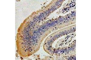 Immunohistochemical analysis of Alpha-crystallin A staining in human colon cancer formalin fixed paraffin embedded tissue section.