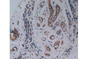IHC-P analysis of Human Breast Cancer Tissue, with DAB staining. (PAK1 anticorps  (AA 252-501))