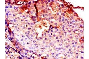 Immunohistochemistry of paraffin-embedded human breast cancer using ABIN7146996 at dilution of 1:100
