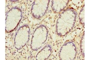 Immunohistochemistry of paraffin-embedded human colon cancer using ABIN7144679 at dilution of 1:100