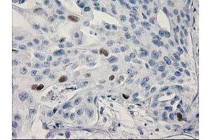 Immunohistochemical staining of paraffin-embedded Carcinoma of Human bladder tissue using anti-TP53 mouse monoclonal antibody. (p53 anticorps)