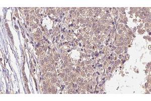 ABIN6266584 at 1/100 staining Human Melanoma tissue by IHC-P. (MLANA anticorps  (Internal Region))