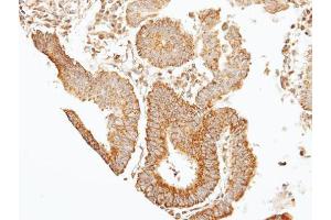 IHC-P Image Immunohistochemical analysis of paraffin-embedded human gastric cancer, using 39331, antibody at 1:100 dilution. (Septin 7 anticorps)