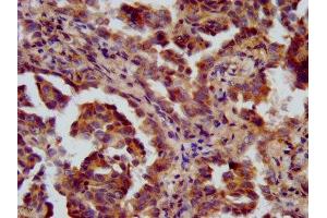 IHC image of ABIN7151021 diluted at 1:600 and staining in paraffin-embedded human lung cancer performed on a Leica BondTM system.