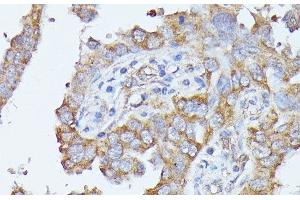 Immunohistochemistry of paraffin-embedded Human lung cancer using HAL Polyclonal Antibody at dilution of 1:100 (40x lens).