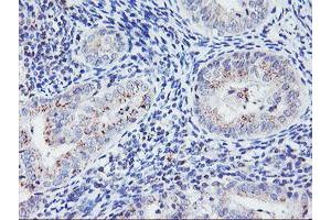 Immunohistochemical staining of paraffin-embedded Adenocarcinoma of Human endometrium tissue using anti-HES1 mouse monoclonal antibody. (HES1 anticorps)