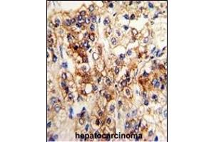 Formalin-fixed and paraffin-embedded human hepatocarcinoma reacted with CYP2J2 Antibody (N-term), which was peroxidase-conjugated to the secondary antibody, followed by DAB staining.