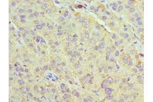 Immunohistochemistry of paraffin-embedded human liver cancer using ABIN7170632 at dilution of 1:100 (U2AF1 anticorps  (AA 1-240))