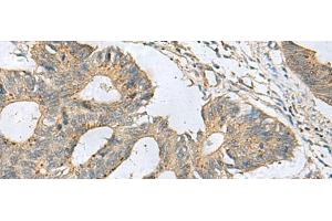 Immunohistochemistry of paraffin-embedded Human colorectal cancer tissue using CXCR5 Polyclonal Antibody at dilution of 1:80(x200) (CXCR5 anticorps)