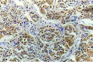 Immunohistochemistry (IHC) analyzes of eIF4E antibody in paraffin-embedded human breast carcinoma tissue. (EIF4E anticorps)