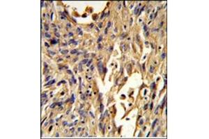 Immunohistochemistry analysis in Formalin Fixed, Paraffin Embedded Human lung carcinoma using S100A10 Antibody (Center) followed by peroxidase conjugation of the secondary antibody and DAB staining. (S100A10 anticorps  (Middle Region))