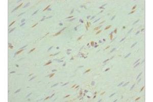Immunohistochemistry of paraffin-embedded human colon cancer using ABIN7168762 at dilution of 1:100 (SEPHS1 anticorps  (AA 1-392))