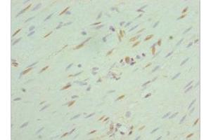 Immunohistochemistry of paraffin-embedded human colon cancer using ABIN7168762 at dilution of 1:100