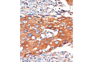 Immunohistochemistry of paraffin-embedded Human breast cancer using IQG Rabbit pAb (ABIN7268022) at dilution of 1:100 (40x lens). (IQGAP2 anticorps  (AA 1330-1440))