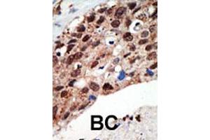 Formalin-fixed and paraffin-embedded human cancer tissue reacted with the SETD7 polyclonal antibody  , which was peroxidase-conjugated to the secondary antibody, followed by DAB staining. (SETD7 anticorps  (Internal Region))