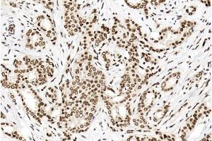 Immunohistochemical analysis of paraffin-embedded human breast cancer tissue using (ABIN1881702 and ABIN2838736). (PTBP1 anticorps  (N-Term))
