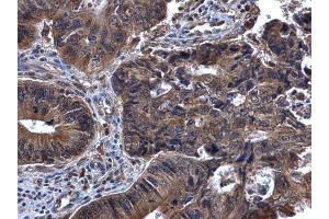 IHC-P Image SYK antibody [N2C2], Internal detects SYK protein at cytoplasm in human cervical cancer by immunohistochemical analysis.