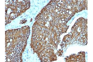 Formalin-fixed, paraffin-embedded human Colon stained with Cadherin 17 / CDH17 Mouse Monoclonal Antibody (CDH17/2618). (LI Cadherin anticorps  (AA 242-418))