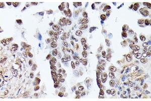 Immunohistochemistry of paraffin-embedded Human lung cancer using TPI1 Polyclonal Antibody at dilution of 1:100 (40x lens). (TPI1 anticorps)