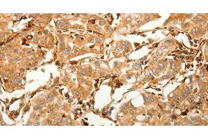 Immunohistochemistry of paraffin-embedded Human lung cancer tissue using SFRP1 Polyclonal Antibody at dilution 1:80 (SFRP1 anticorps)