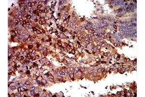 Immunohistochemical analysis of paraffin-embedded endometrial cancer tissues using C3C mouse mAb with DAB staining. (Complement C3c anticorps  (AA 1521-1649))