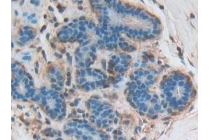 DAB staining on IHC-P; Samples: Human Breast cancer Tissue