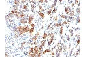 Formalin-fixed, paraffin-embedded human gastric carcinoma stained with MUC5 antibody (MUC5AC/917). (MUC5AC anticorps)