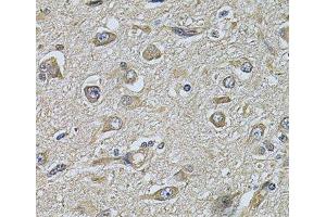 Immunohistochemistry of paraffin-embedded Human brain cancer using WIPI1 Polyclonal Antibody at dilution of 1:100 (40x lens). (WIPI1 anticorps)