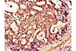 Immunohistochemistry of paraffin-embedded human gastric cancer using ABIN7173790 at dilution of 1:100 (RANKL anticorps  (AA 73-306))