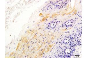 Formalin-fixed and paraffin embedded human esophageal cancer labeled with Anti-β-catenin/Catenin β Polyclonal Antibody, Unconjugated  at 1:200 followed by conjugation to the secondary antibody and DAB staining.