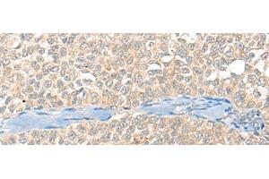 Immunohistochemistry of paraffin-embedded Human ovarian cancer tissue using SNX6 Polyclonal Antibody at dilution of 1:40(x200) (SNX6 anticorps)