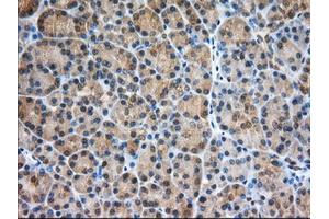 Immunohistochemical staining of paraffin-embedded Adenocarcinoma of Human ovary tissue using anti-PDE4A mouse monoclonal antibody. (PDE4A anticorps)