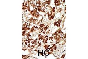 Formalin-fixed and paraffin-embedded human cancer tissue reacted with the primary antibody, which was peroxidase-conjugated to the secondary antibody, followed by AEC staining.