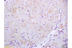 Formalin-fixed and paraffin embedded human gastric carcinoma labeled with Anti ROCK2 Polyclonal Antibody, Unconjugated (ABIN673359) at 1:200 followed by conjugation to the secondary antibody and DAB staining (ROCK2 anticorps  (AA 1001-1300))