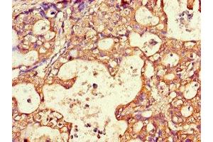 Immunohistochemistry of paraffin-embedded human gastric cancer using ABIN7144511 at dilution of 1:100 (AQP3 anticorps  (AA 210-244))