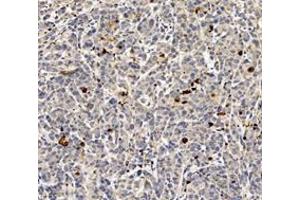 Immunohistochemistry of paraffin embedded human subcutaneous transplant tumor(MCF-7)using c-caspase3 (ABIN7073336) at dilution of 1:600 (200x lens)